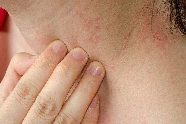 Qui connaît un dermato spécialisé dans le traitement du psoriasis ?